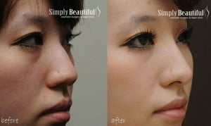 قبل و بعد از تزریق ژل بینی