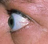 این چشم نشان دهنده پرکاری تیروئید است
