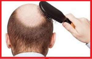 عوامل کاهش دهنده ریزش موها