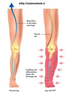 تورو و درد در پشت ساق پا از علایم لخته خون در بدن