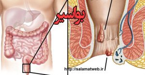 روش تشخیص و درمان بواسیر