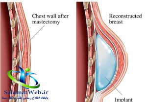 عوارض ناشی از جراحی بزرگ کردن سینه