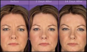 botox 4
