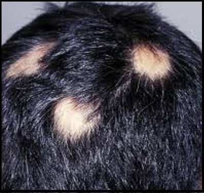 ریزش موی سکه ای از علل پیدایش تا درمان آن