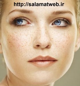 روش های خانگی درمان لکه های روی پوست