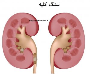 درمان خانگی سنگ کلیه