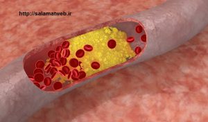 تغذیه مناسب در کاهش میزان چربی خون