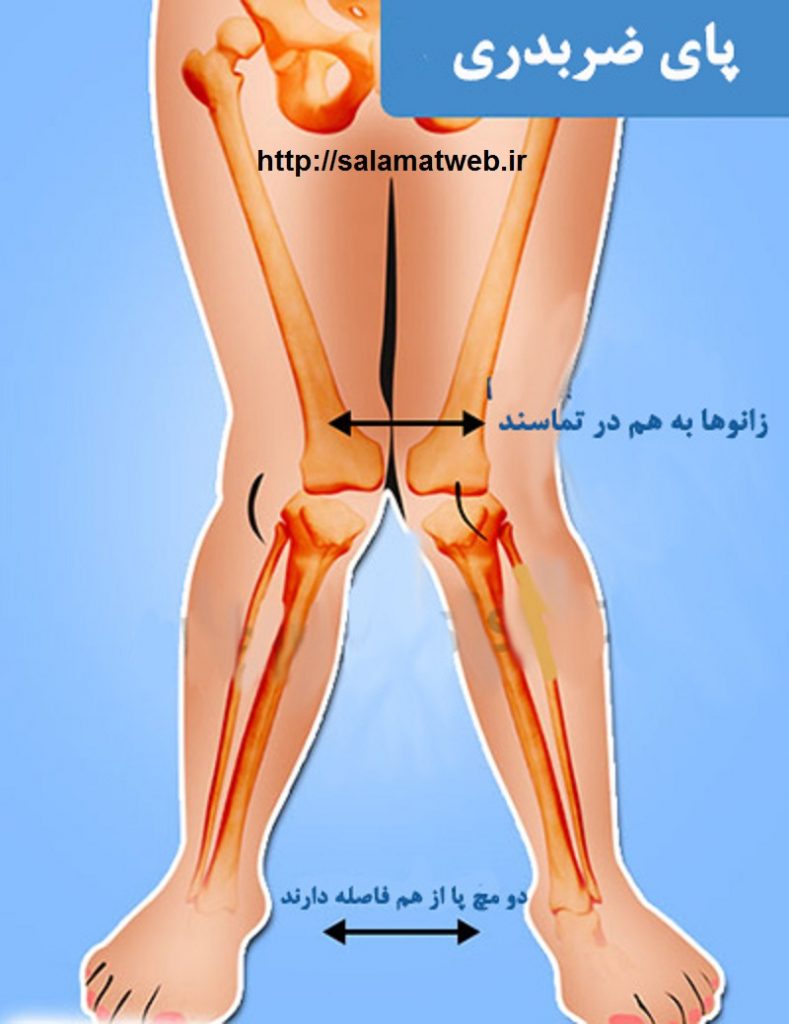 ضربدری بودن پا