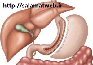 جراحی اسلیو معده چیست؟