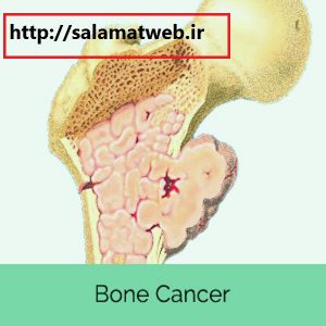 سرطان استخوان چیست؟
