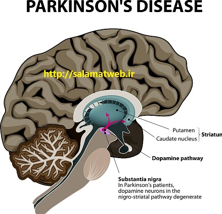 نشانه های بیماری پارکینسون