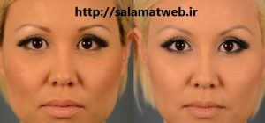 بوتاکس چیست؟