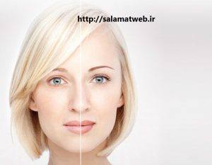 تکنیک IPLچیست؟