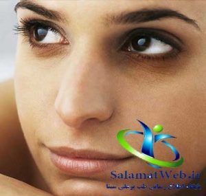 تیرگی های زیر چشم چیست؟