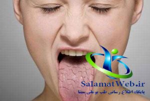 خشکی دهان