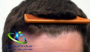کاشت مو به روش FITچه مزایایی دارد؟