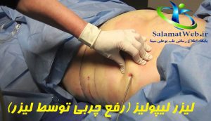 مزایای لیپولیز