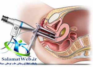 مراقبت های پس از هیستروسکوپی