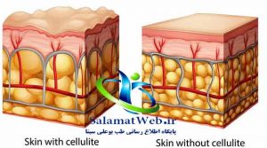 لیزر تری اکتیو و بهبود ساختار پوست