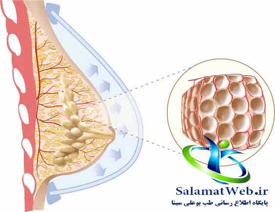 تزریق چربی برای بزرگتر کردن سینه های کوچک