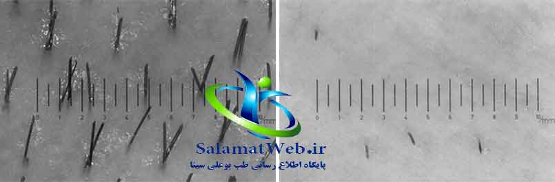 نحوه عملکرد لیزر دایود