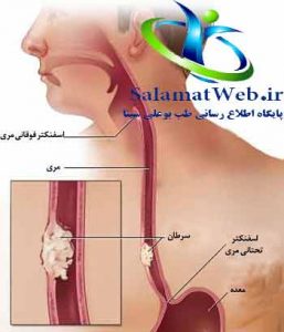 سرطان مری چیست؟