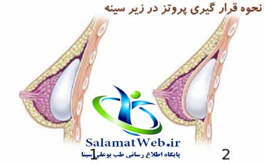 جراحی پروتز سینه برای بزرگ کردن سینه های کوچک