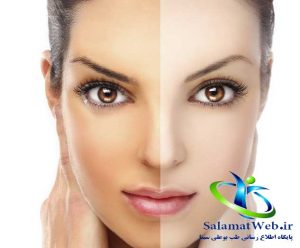 روشن شدن رنگ پ.ست با کرم سفید کننده و روشن کننده