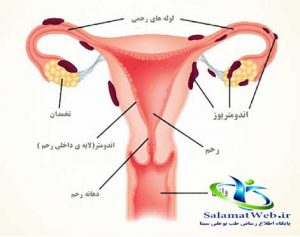 آندومتریوز چیست؟