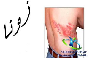بیماری زونا چیست