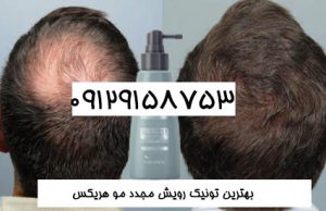 جدیدترین درمان ریزش موی ارثی