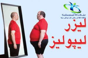 لیزر لیپولیز چیست؟
