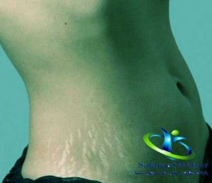 پیشگیری از ترک شکم