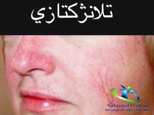 تلانژکتازی