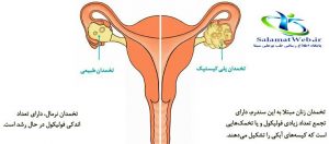 تخمدان پلی کیستیک و ناباروری