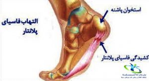 عکس خار پاشنه