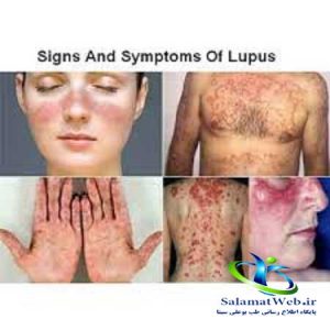آیا بیماری لوپوس خطرناک است؟