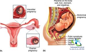 علل بارداری خارج از رحم