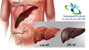 درمان فوری کبد چرب