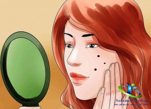 لک های قهوه ای پوست صورت