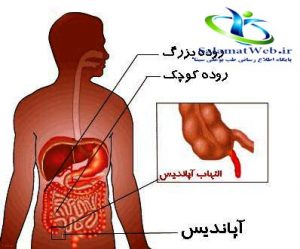 التهاب آپاندیس