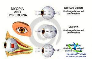 آستیگماتیسم چشم چیست