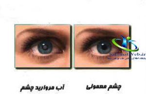 علت آب مروارید