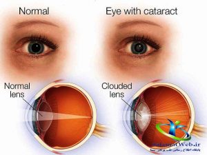علت آب مروارید چشم