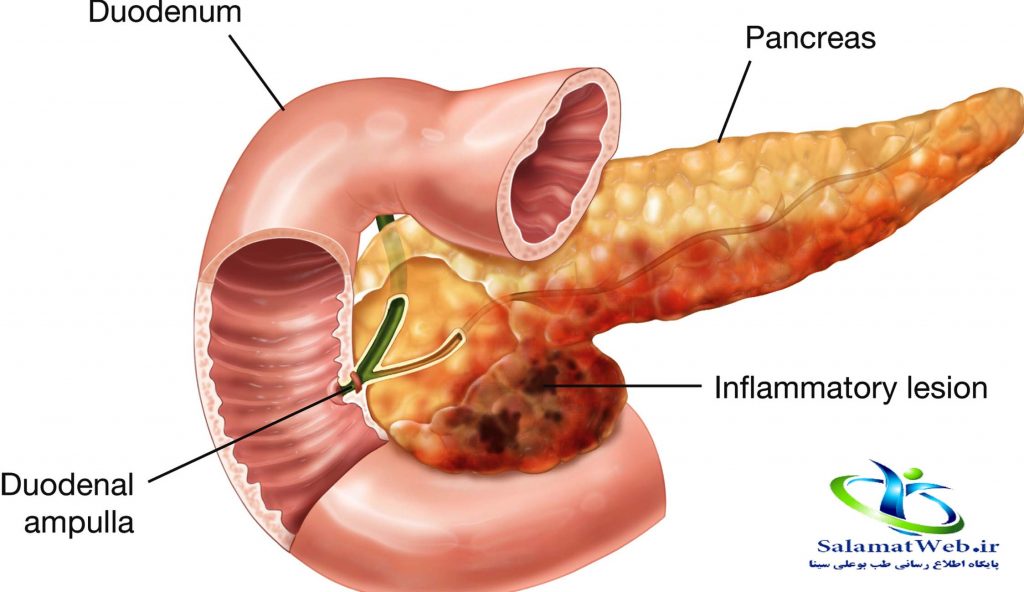 بیماری پانکراتیت