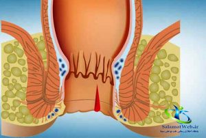 درمان خانگی خونریزی مقعدی