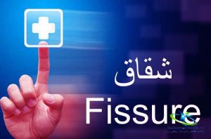 شقاق روده