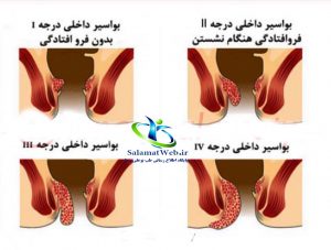 درمان بواسیر در زنان