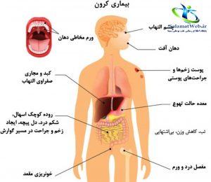 علایم بیماری کرون