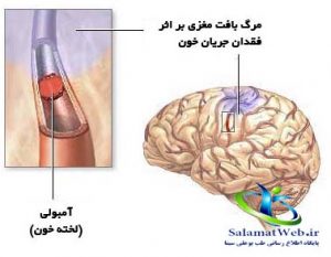 تشخیص سکته مغزی